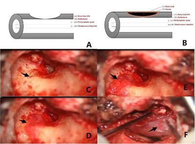 Analysis of postoperative effects of different semicircular canal surgical technique in patients with labyrinthine fistulas